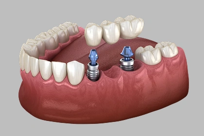 Implant-supported dental bridge replacing missing teeth
