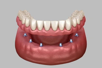 Implant-supported dentures for replacing missing teeth
