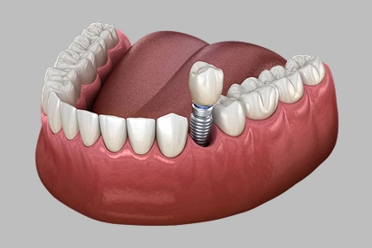 Single dental implant crown replacing a missing tooth