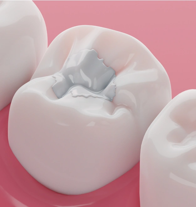 Restoring Damaged Teeth with a Natural-Looking Solution