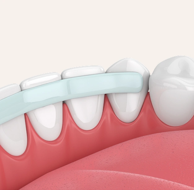 A Simple Fix for Everyday Smile Imperfections