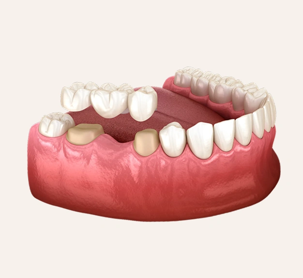 Closing the Gap Left by Missing Teeth