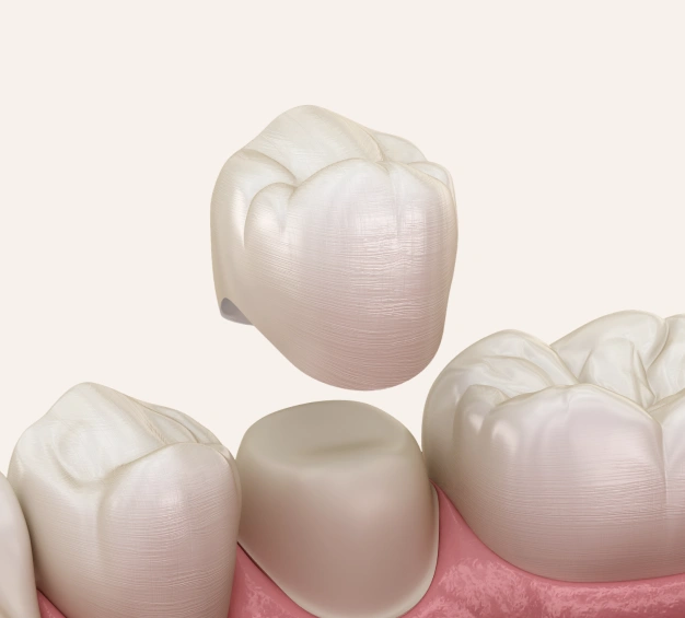 Rebuilding Strength for Damaged Teeth