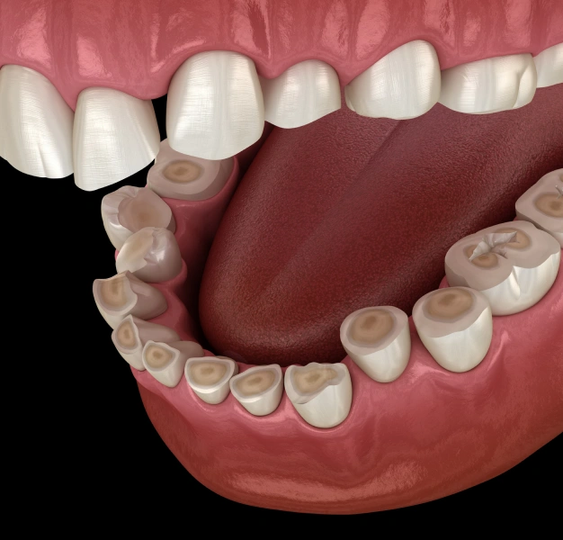 Restoring Balance to an Uneven Bite