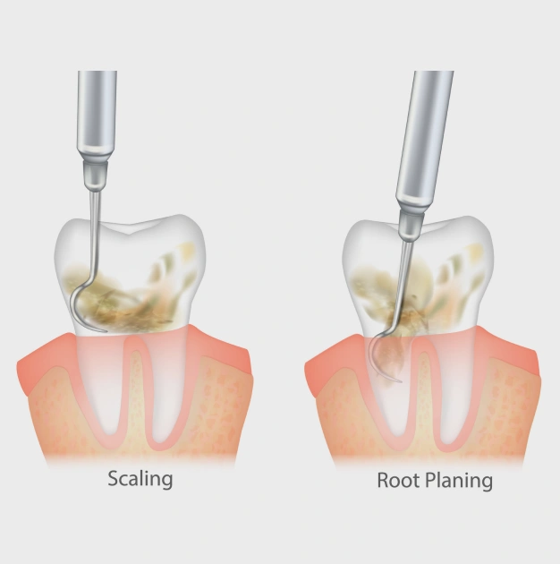 Scaling and root planing treatment for gum disease